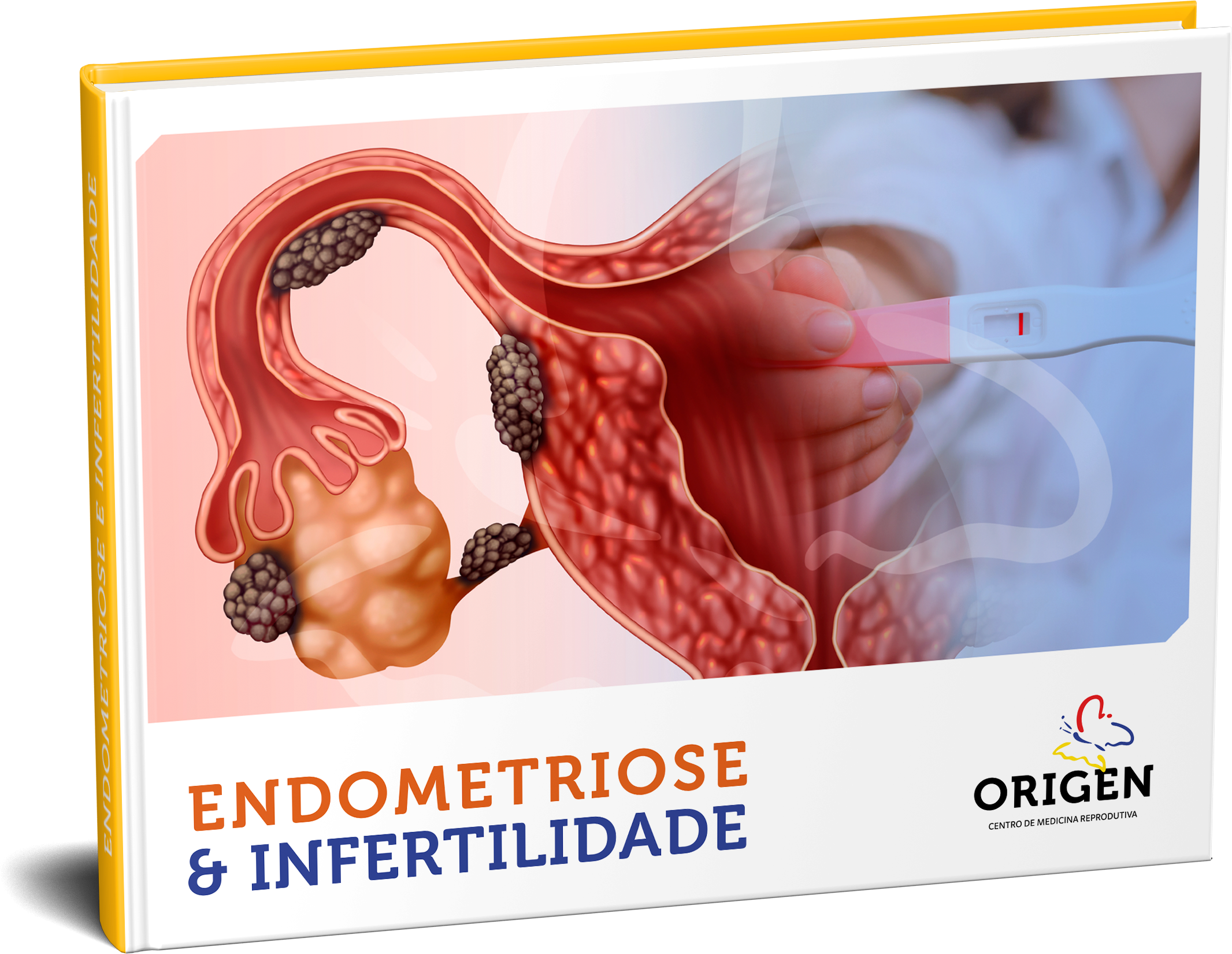 E-book | Endometriose e infertilidade